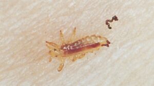 Mistanke om hovedlus